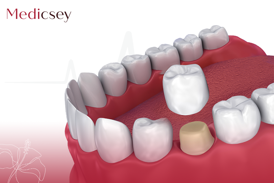 Zirconium Crowns in Turkey Medicsey